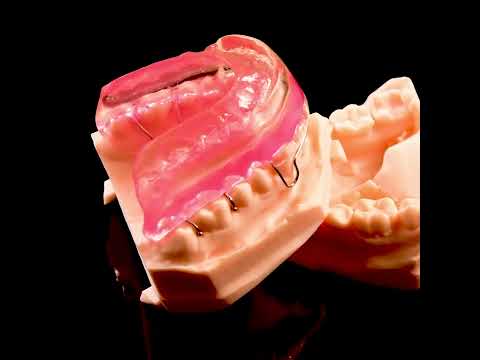 Activator - Ortho Appliance