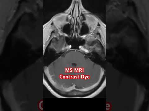 MS MRI Contrast Dye